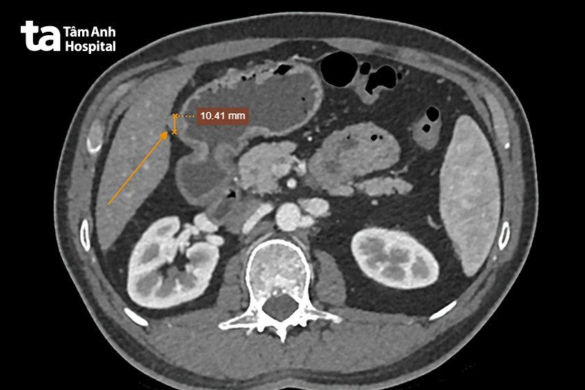 hình ảnh hạch dạ dày của bệnh nhân
