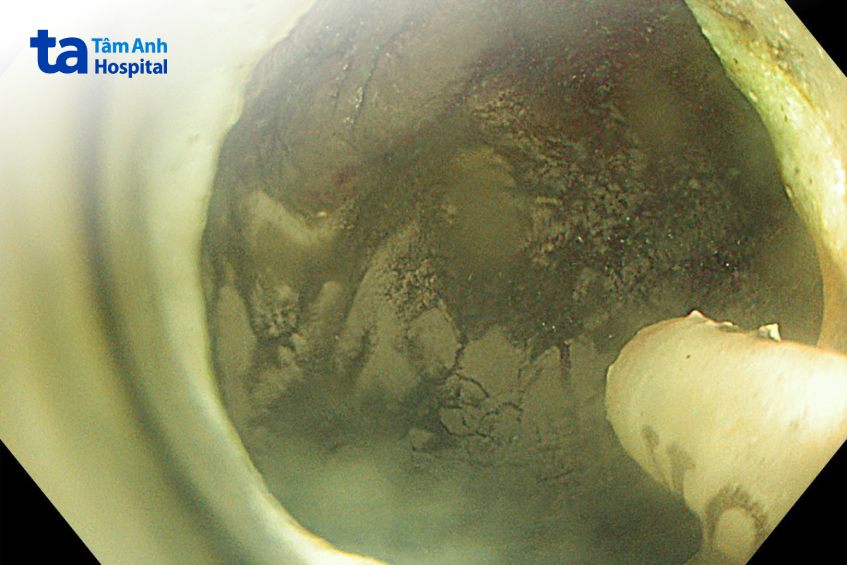 hình ảnh lớp bột cầm máu