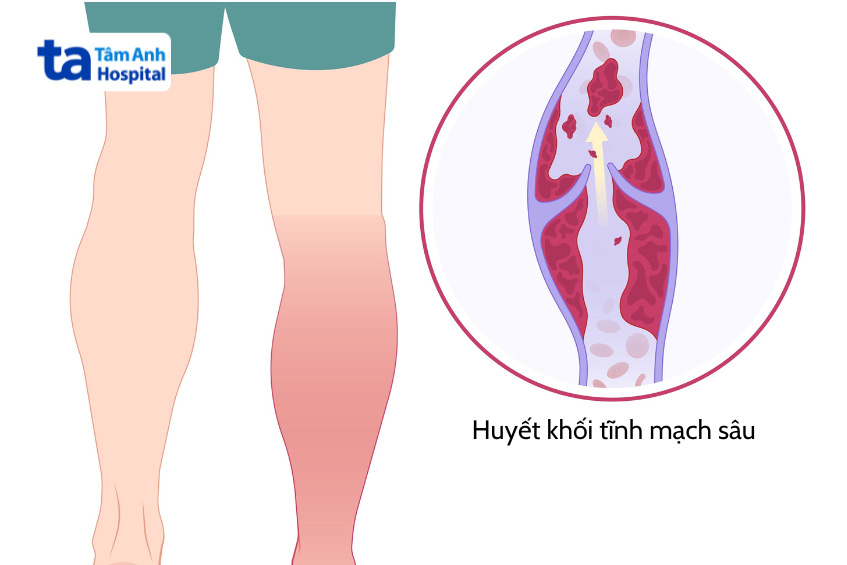 Hình ảnh minh họa tình trạng thuyên tắc huyết khối tĩnh mạch sâu