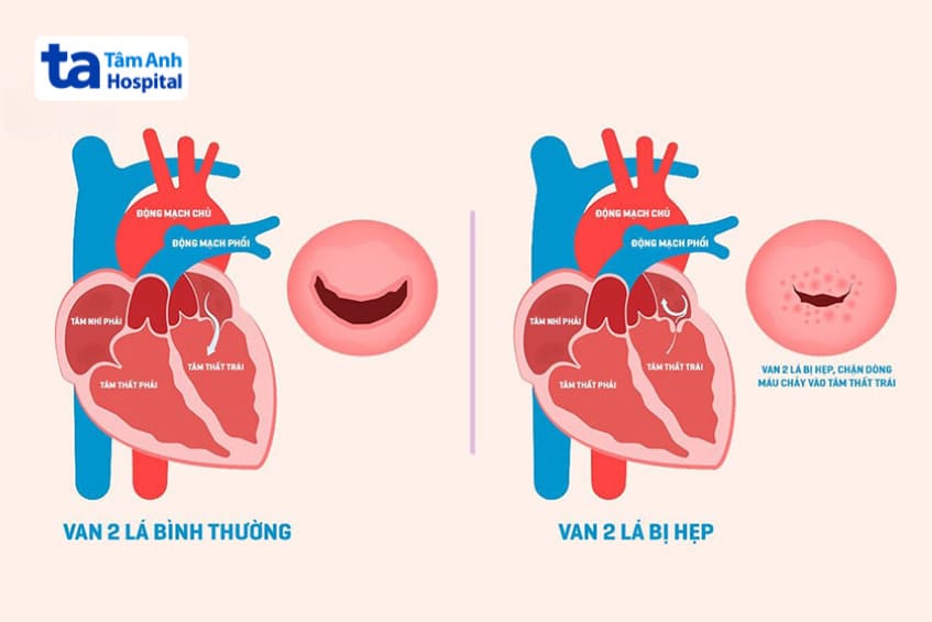Hình ảnh minh họa tình trạng van tim 2 lá bị hẹp