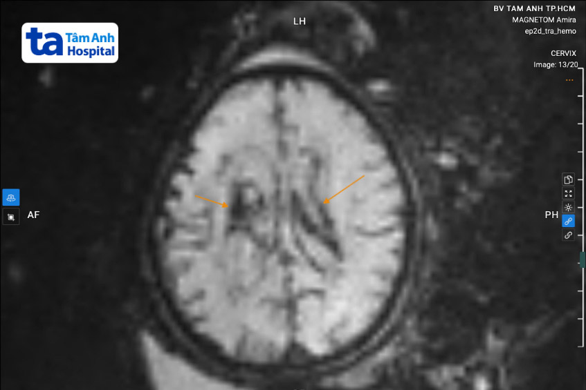 hình ảnh mri não thai