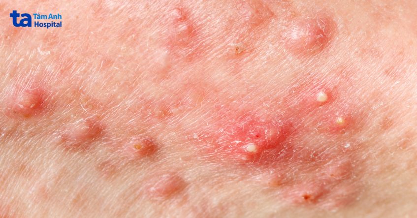hình ảnh mụn cứng dưới da