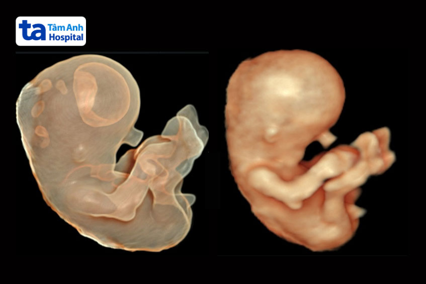 hình ảnh siêu âm thai