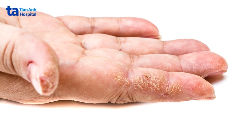 hình ảnh tay bị viêm da cơ địa