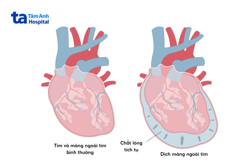 Hình ảnh trái tim bình thường và trái tim có dịch màng ngoài tim