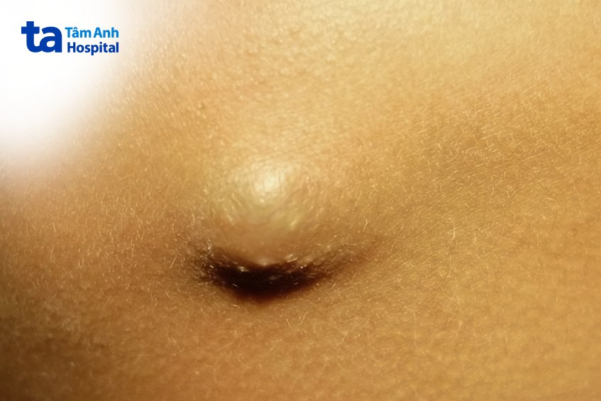 hình ảnh u bã đậu ở mông của người bệnh