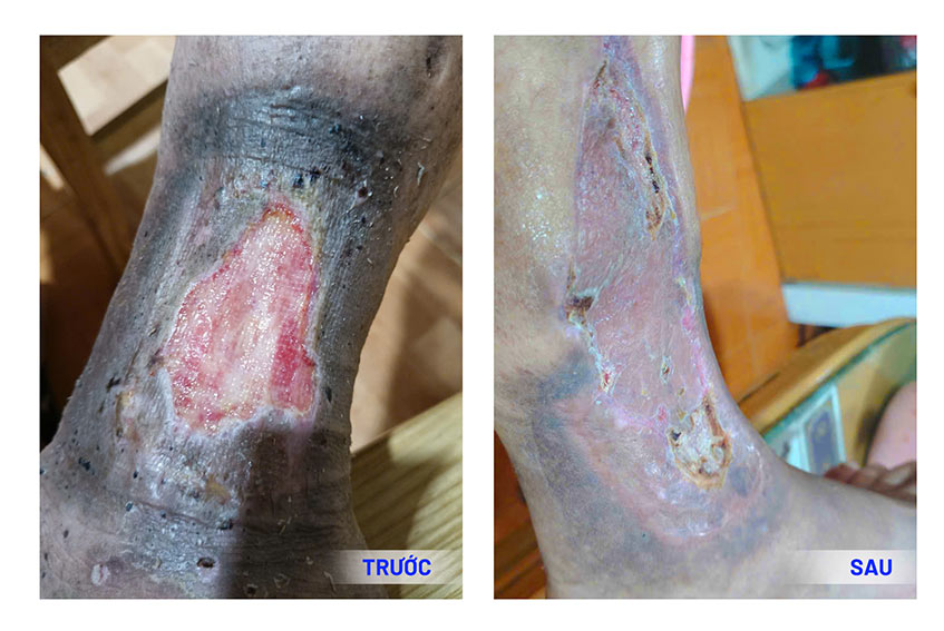 Hình ảnh vết loét tại chân bệnh nhân Tâm trước và sau khi điều trị