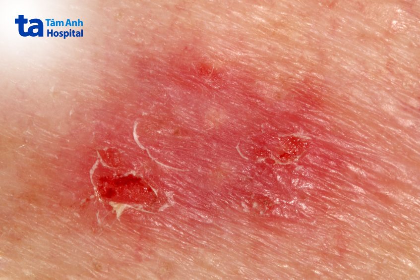 hình bệnh ung thư biểu mô tế bào đáy