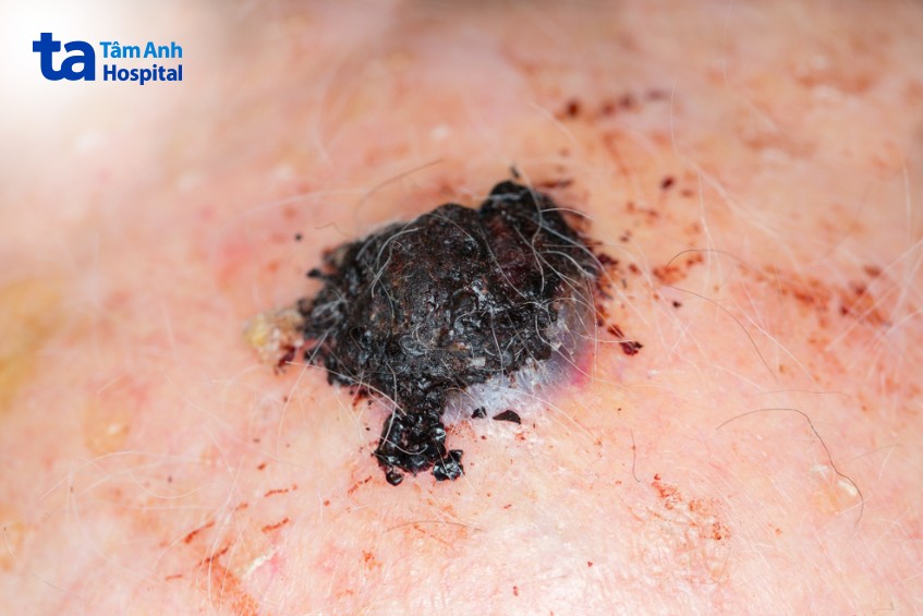 hình bệnh ung thư hắc tố da