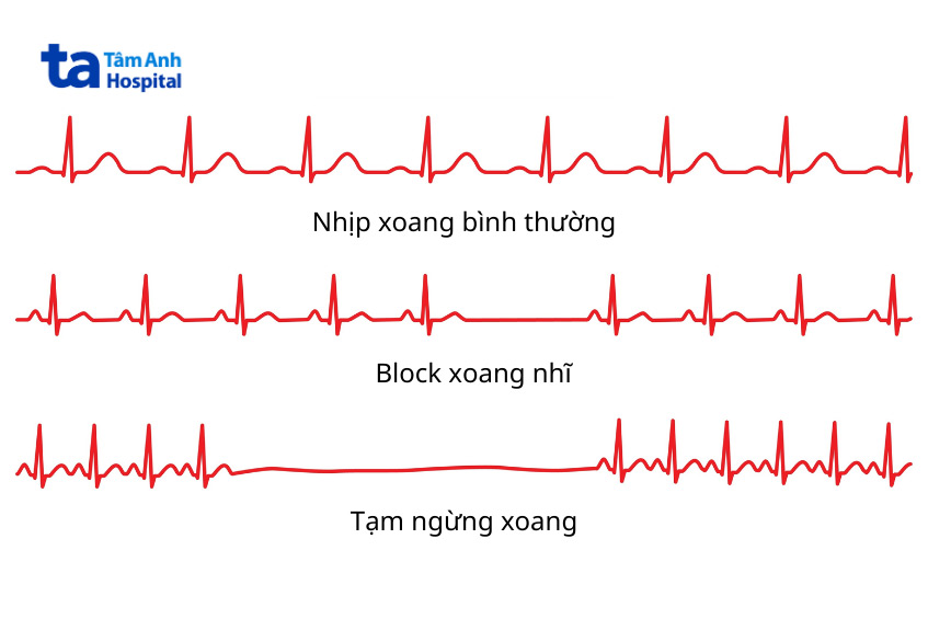 Hình ảnh minh họa ECG thể hiện các tình trạng của nút xoang nhĩ