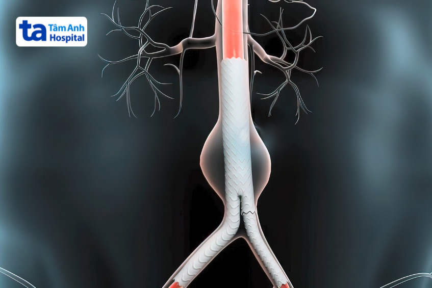 Hình ảnh minh họa bệnh phình động mạch chủ bụng