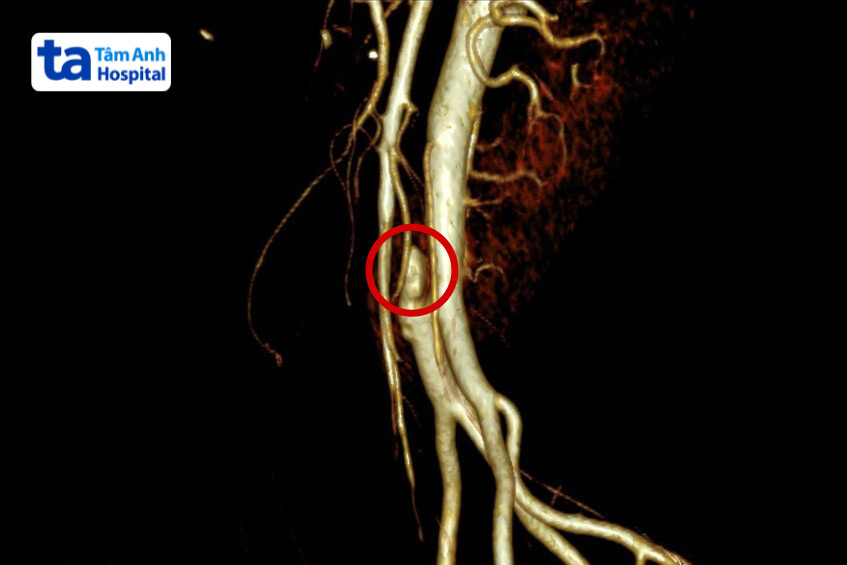 Hình ảnh bệnh phình động mạch chủ chậu trên CT
