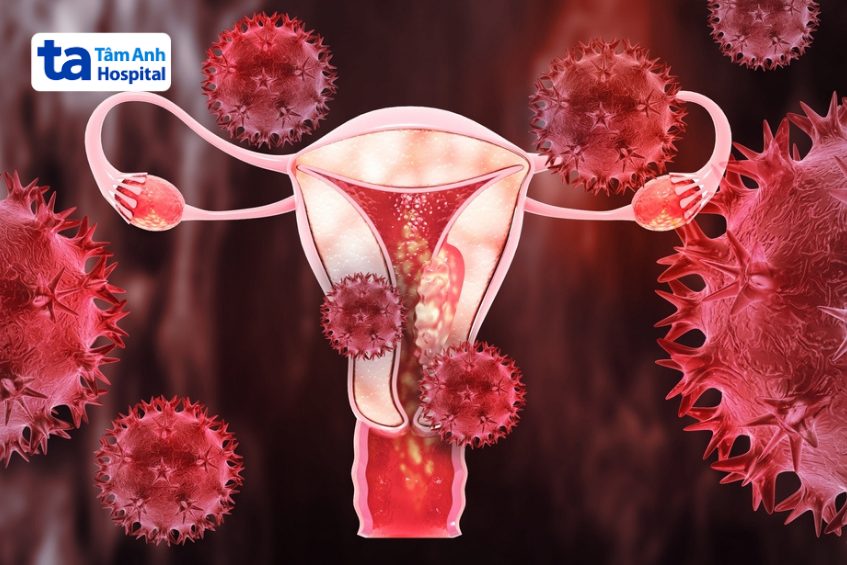 hpv type 18 nguyên nhân hàng đầu gây ung thư cổ tử cung