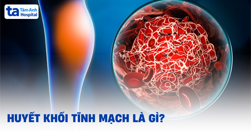 Bệnh huyết khối tĩnh mạch là gì?