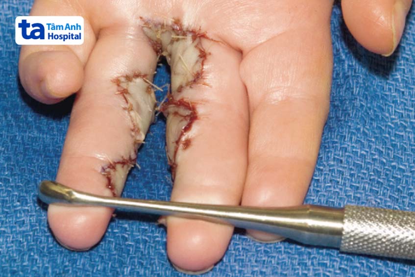 Kết quả ngay sau phẫu thuật