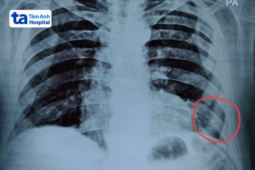 kết quả chụp x-quang xương sườn