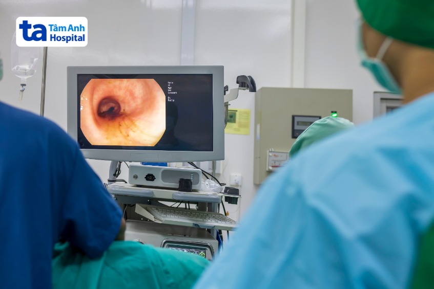 khi nào cần nội soi tiêu hóa không đau