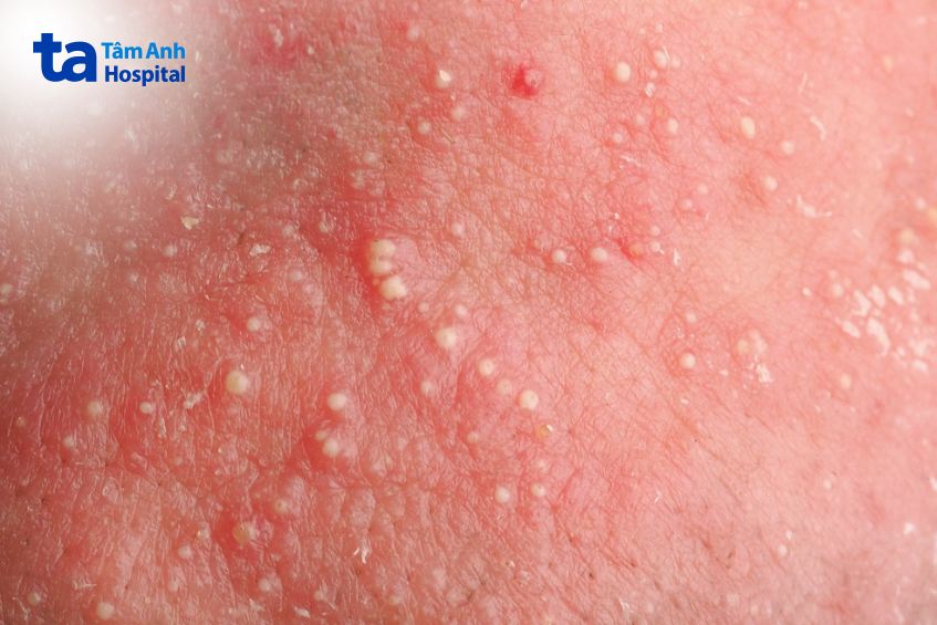 khi nào cần xét nghiệm 36 dị nguyên