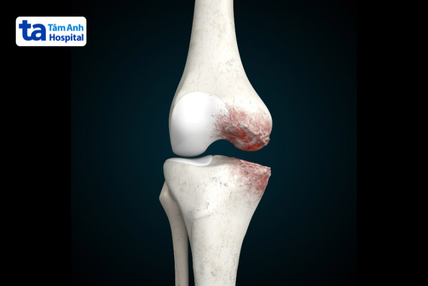 Khô dịch khớp gối