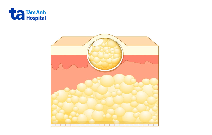 khối u mô mềm lành tính