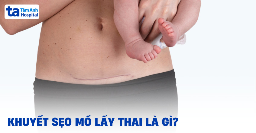Khuyết sẹo mổ lấy thai là gì?