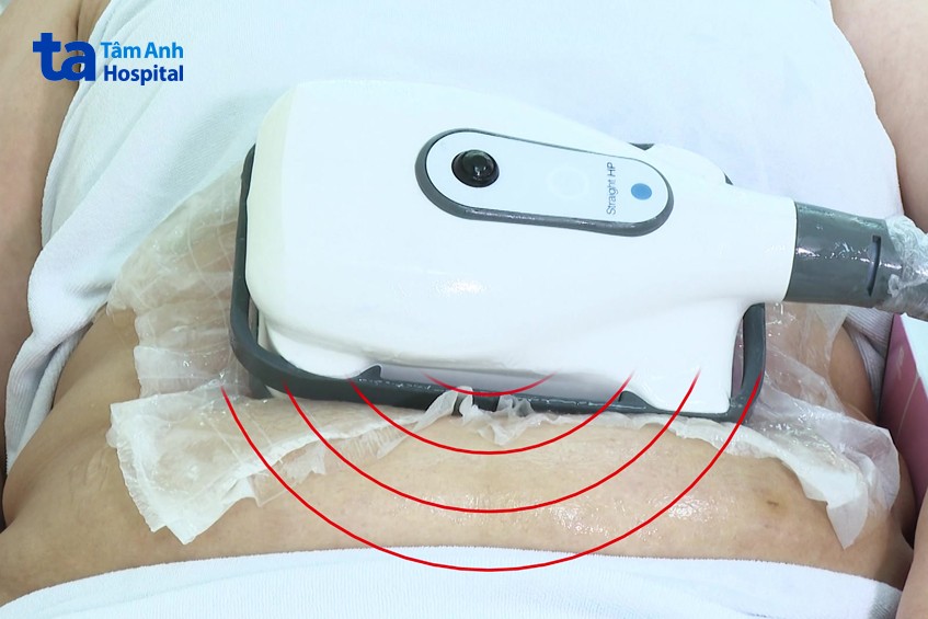 kỹ thuật đông hủy mỡ