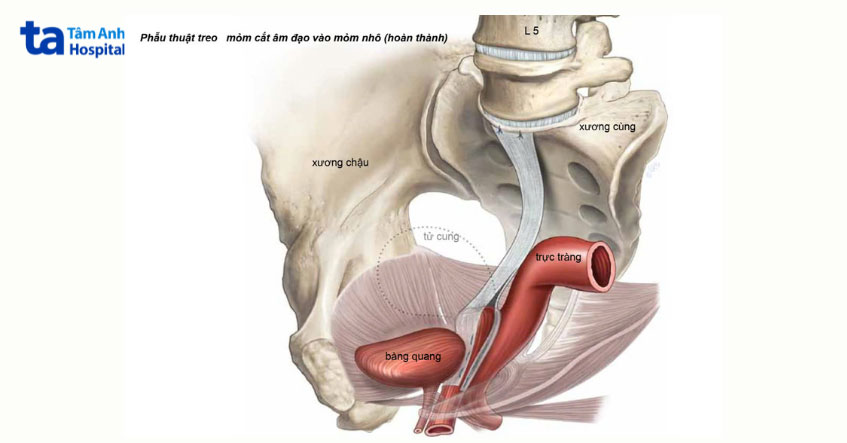 kỹ thuật sacrocolpopexy