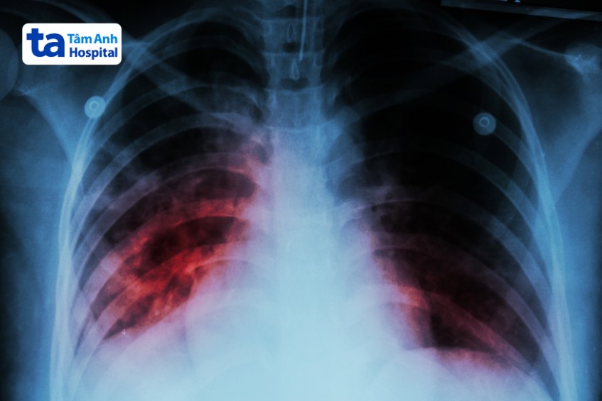 Lao phổi giai đoạn cuối là giai đoạn bùng phát nghiêm trọng