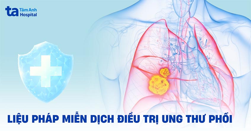 Liệu pháp miễn dịch trong điều trị ung thư phổi có những ưu điểm gì?