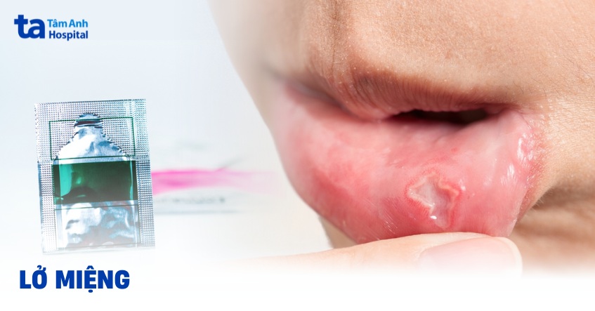 Lở miệng là gì? 9 nguyên nhân gây bệnh và cách phòng ngừa