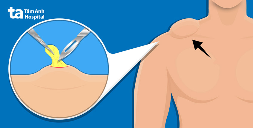 loại bỏ bằng phẫu thuật