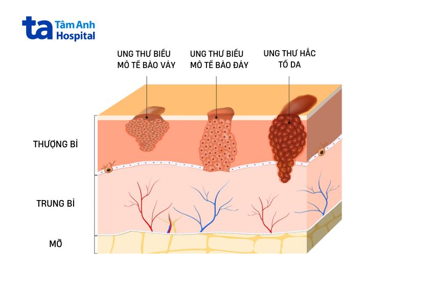 Các loại ung thư da phổ biến