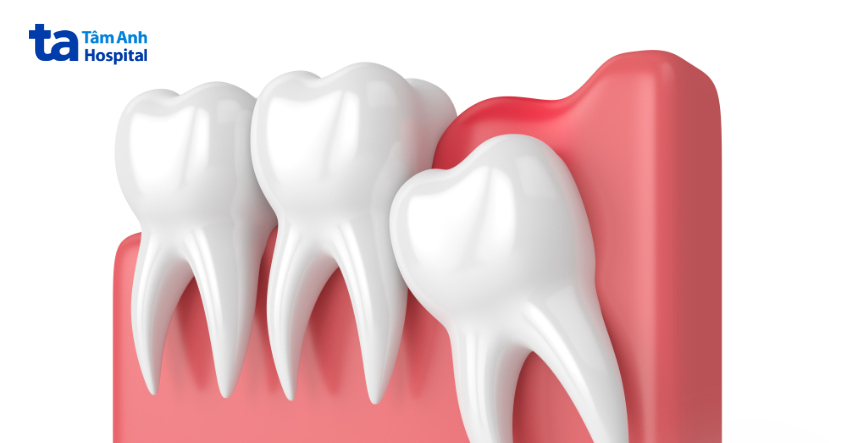 Lợi trùm răng khôn là gì