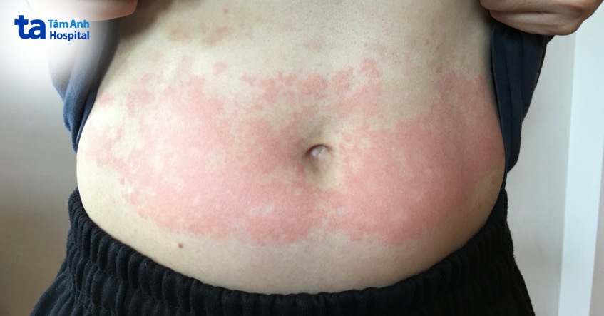 lupus ban đỏ hệ thống là nguyên nhân