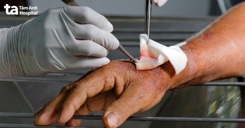 lưu ý khi điều trị mụn thịt