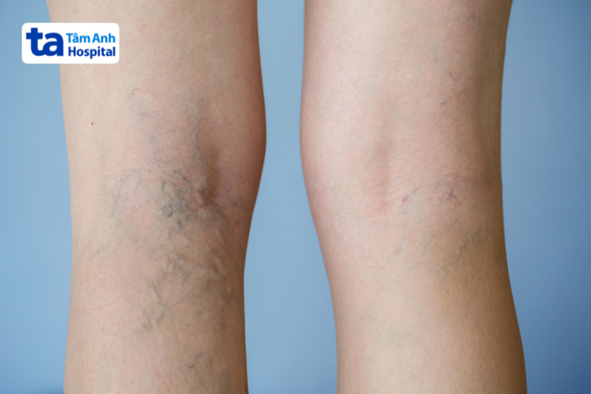 Những mạch máu bị tắc nghẽn khiến người bệnh đau nhức