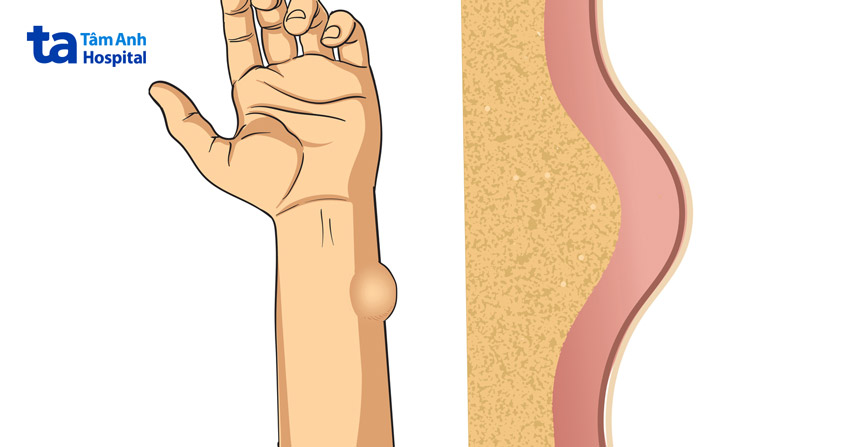 mềm và nhão khi chạm vào