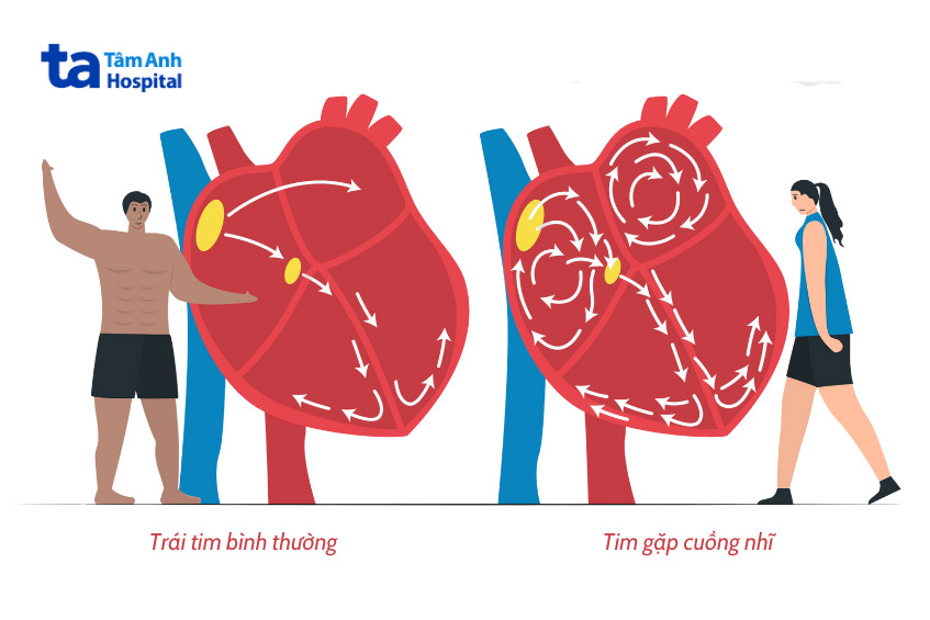 Hình ảnh minh họa tim hoạt động bình thường (bên trái) và tim gặp tình trạng cuồng nhĩ (bên phải)