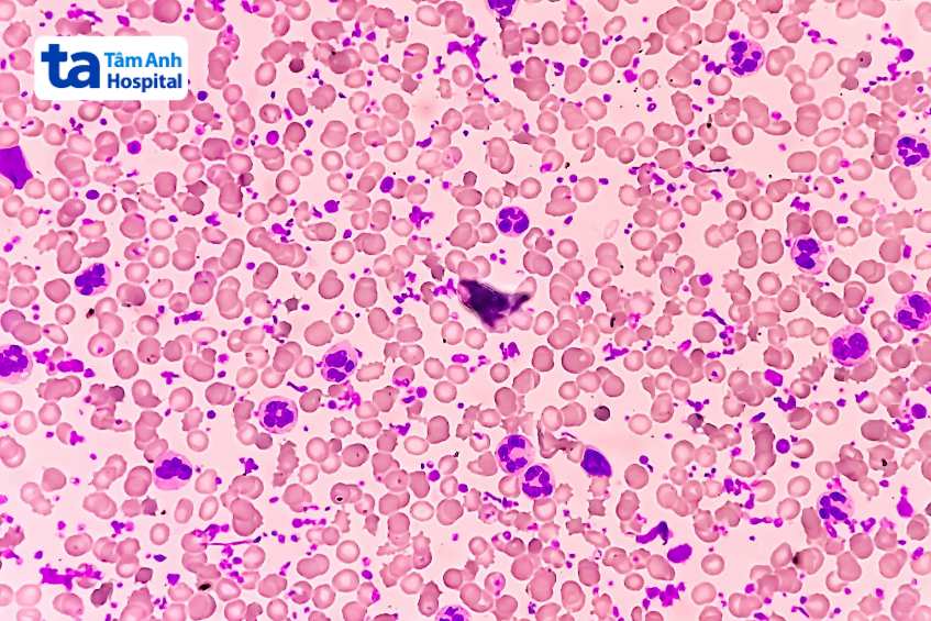 minh họa tình trạng tăng tiểu cầu