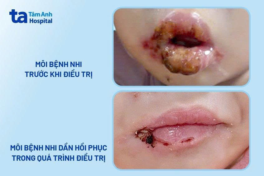 Môi bệnh nhân trước và sau quá trình điều trị bệnh