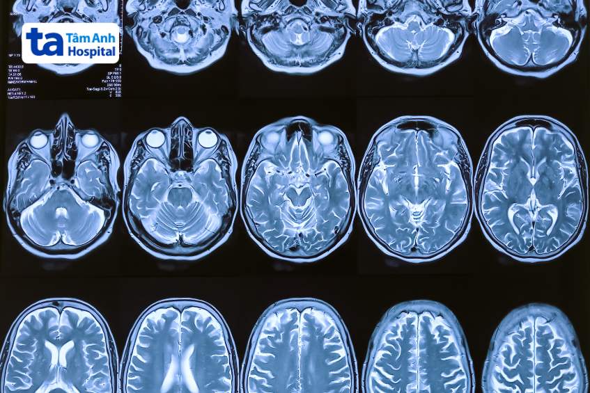 mri chẩn đoán bệnh teo não ở người trẻ tuổi