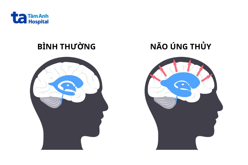 người bệnh xuất huyết dưới nhện có thể gặp biến chứng não úng thủy