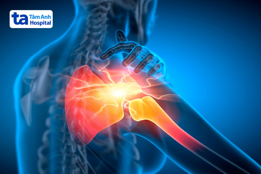 Bệnh khô khớp vai là gì?