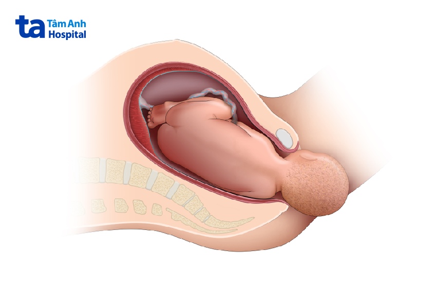 nguyên nhân nữ bị sa bàng quang
