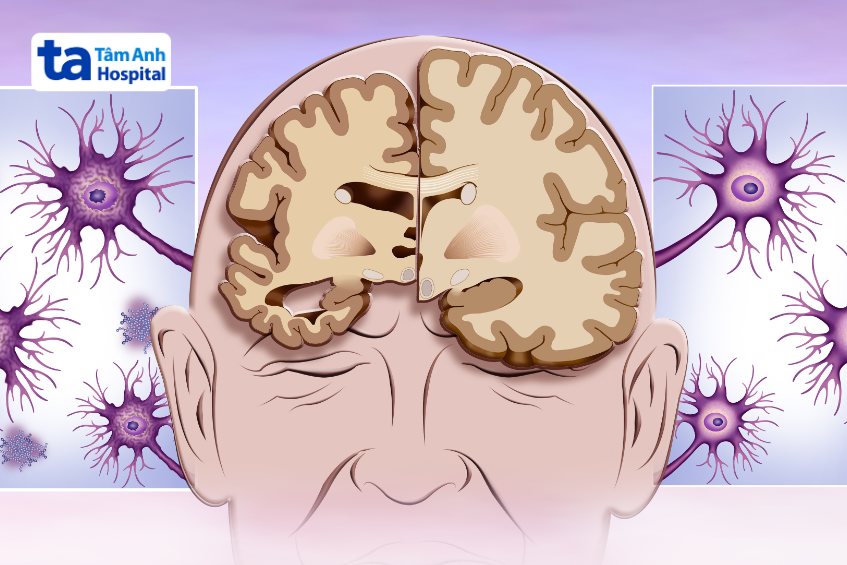 nguyên nhân teo não ở người trẻ khác nhau