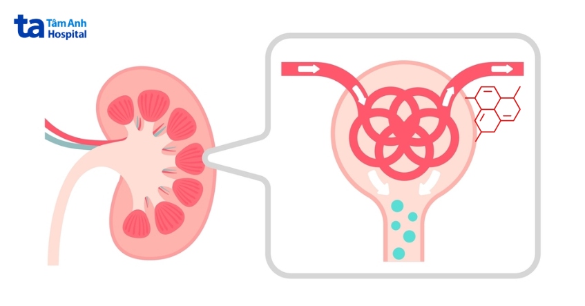 nguyên nhân viêm cầu thận tăng sinh màng