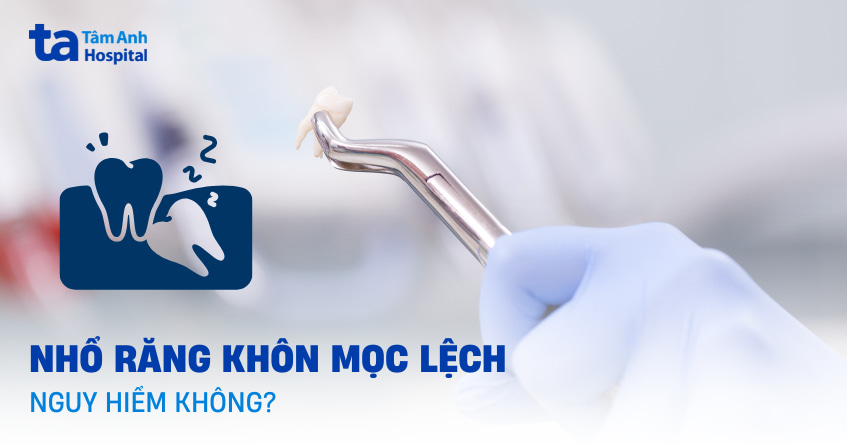 Có nên nhổ răng khôn mọc lệch không? Có nguy hiểm không?