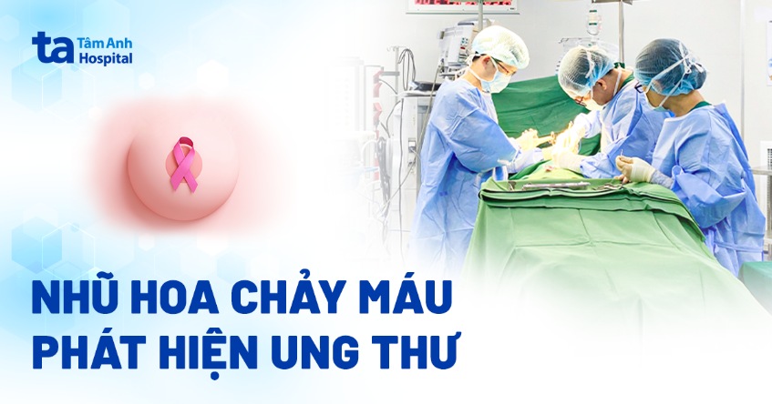 Nhũ hoa chảy máu, phát hiện ung thư