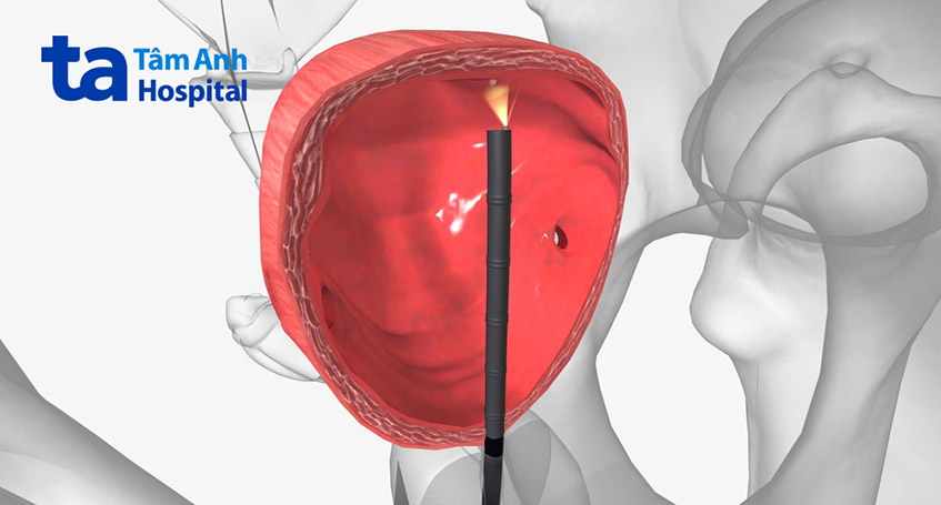 Nội soi bàng quang