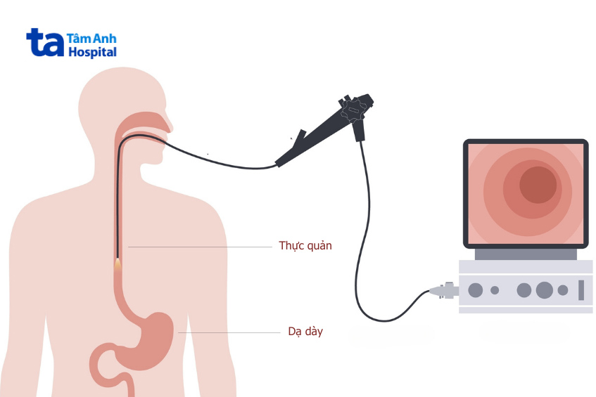 Nội soi giúp chẩn đoán trào ngược dạ dày gây ho ở trẻ em